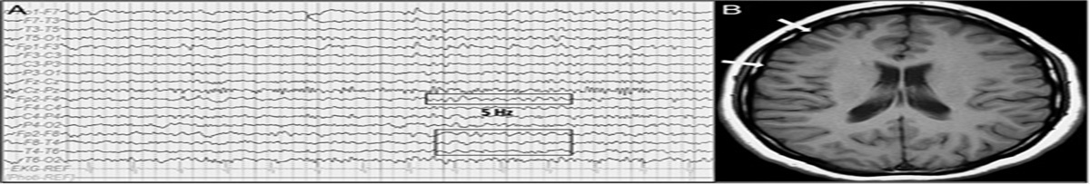 Polymicrogyria: An Unusual Case of Secondary Mania