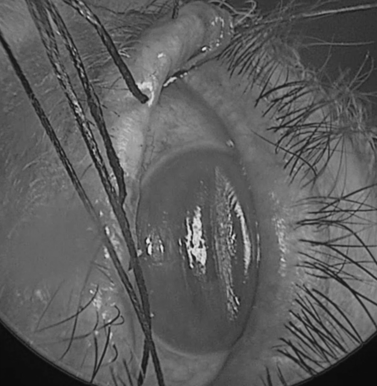 Ocular Hypotony After Extraocular Muscle Biopsy for a Patient With Orbital Myositis