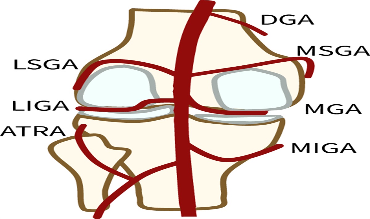 Genicular Artery Embolization for Knee Osteoarthritis: A Comprehensive Review