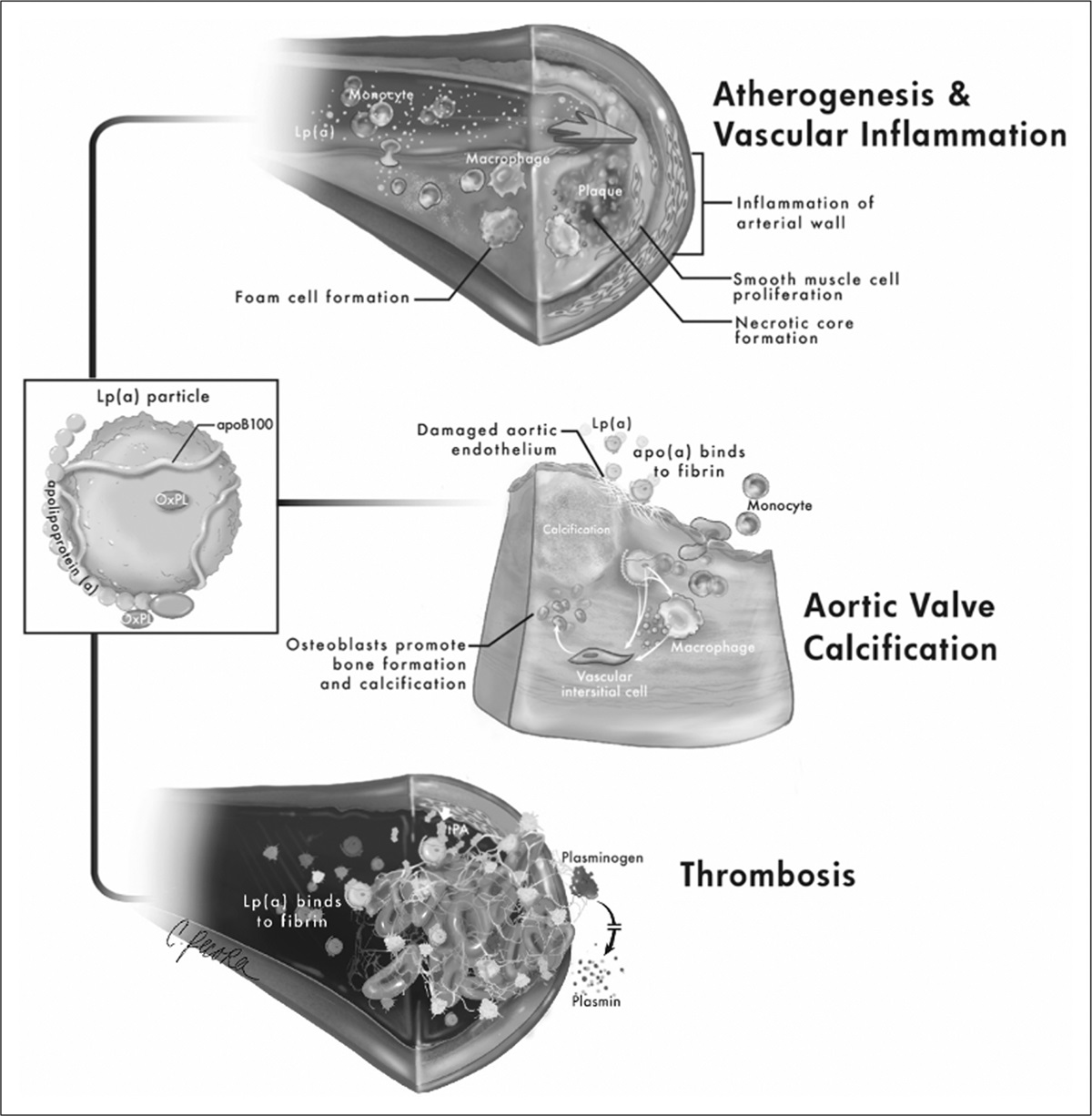 Aspirin and lipoprotein(a) in primary prevention