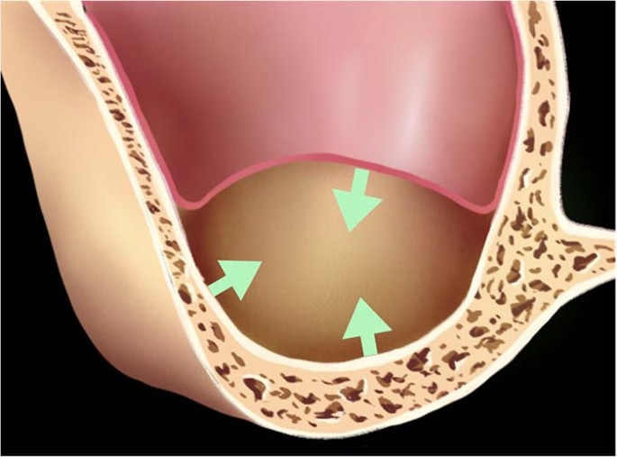 Maxillary sinus floor augmentation: a review of current evidence on anatomical factors and a decision tree