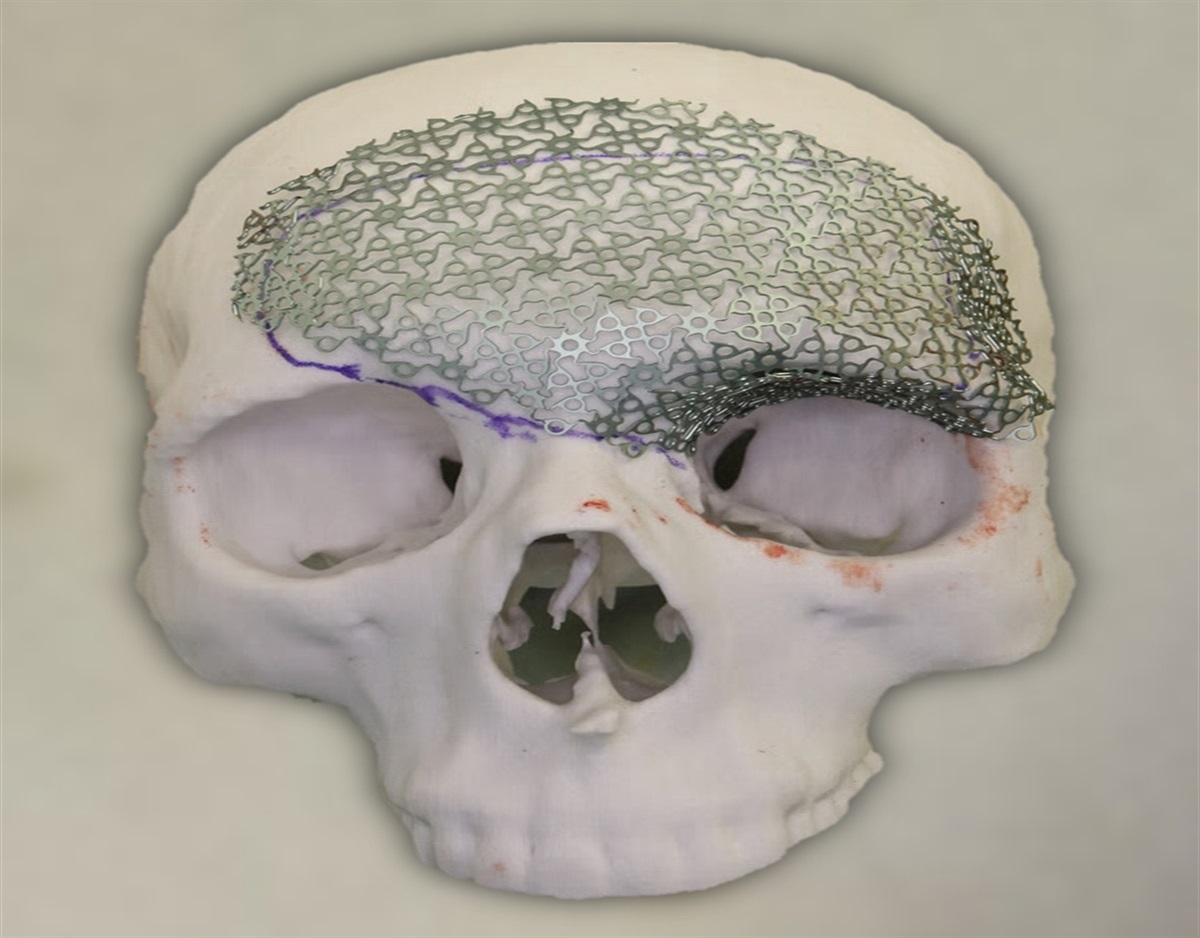 A Comparative Study of Titanium Cranioplasty for Extensive Calvarial Bone Defects: Three-Dimensionally Printed Titanium Implants Versus Premolded Titanium Mesh