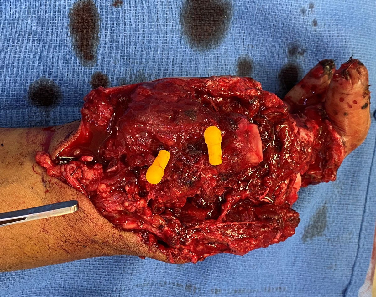 The Superficial Circumflex Iliac Artery Perforator Flap for Devastating Hand Injuries in Obese Patients