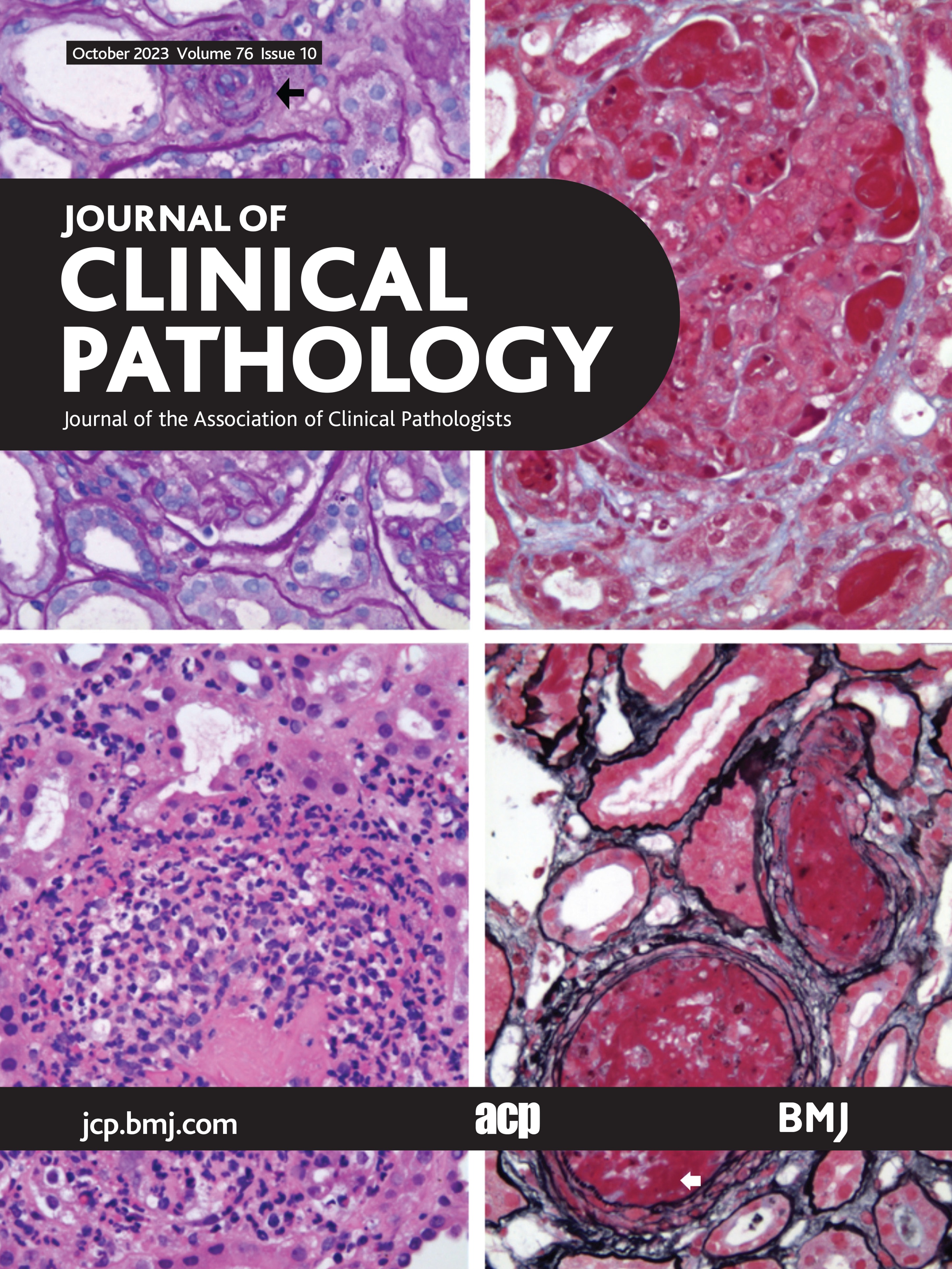 Through the looking crystal: clarifying the pathogenesis and laboratory work-up of cryocrystalglobulinaemia
