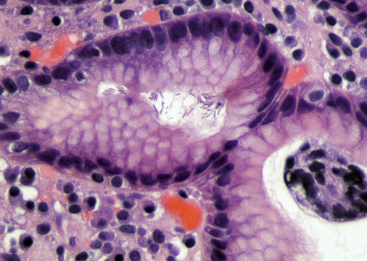 A Case of Helicobacter heilmannii Gastritis in a Patient With Human Immunodeficiency Virus