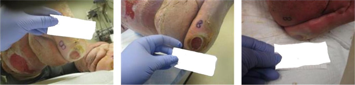 Shewanella algae, an Emerging Pathogen, Causing Skin and Soft Tissue Infections