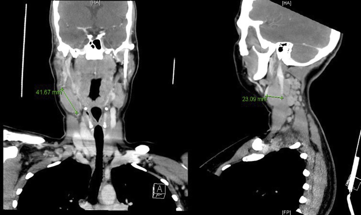 Bartonella henselae Infection With Concurrent Latent Syphilis in a Patient With Unexplained Generalized Lymphadenopathy: A Case Report