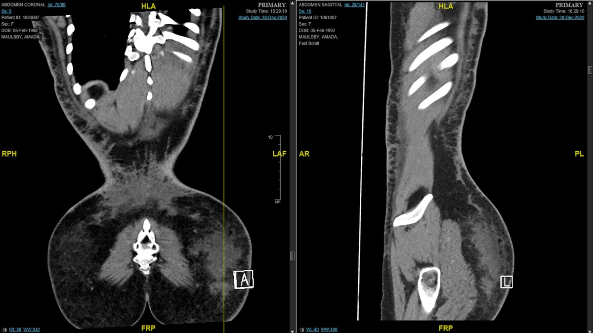 Infectious and Noninfectious Complications After Gluteal Augmentation Surgery