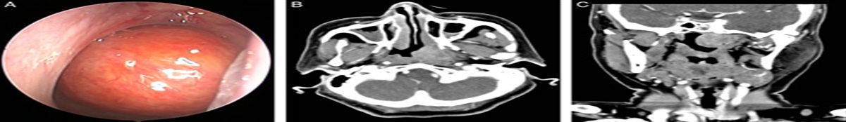 Clinical and Histopathologic Analyses of Nasopharyngeal Hyalinizing Clear Cell Carcinoma: A Series of 26 Cases With Molecular Confirmation