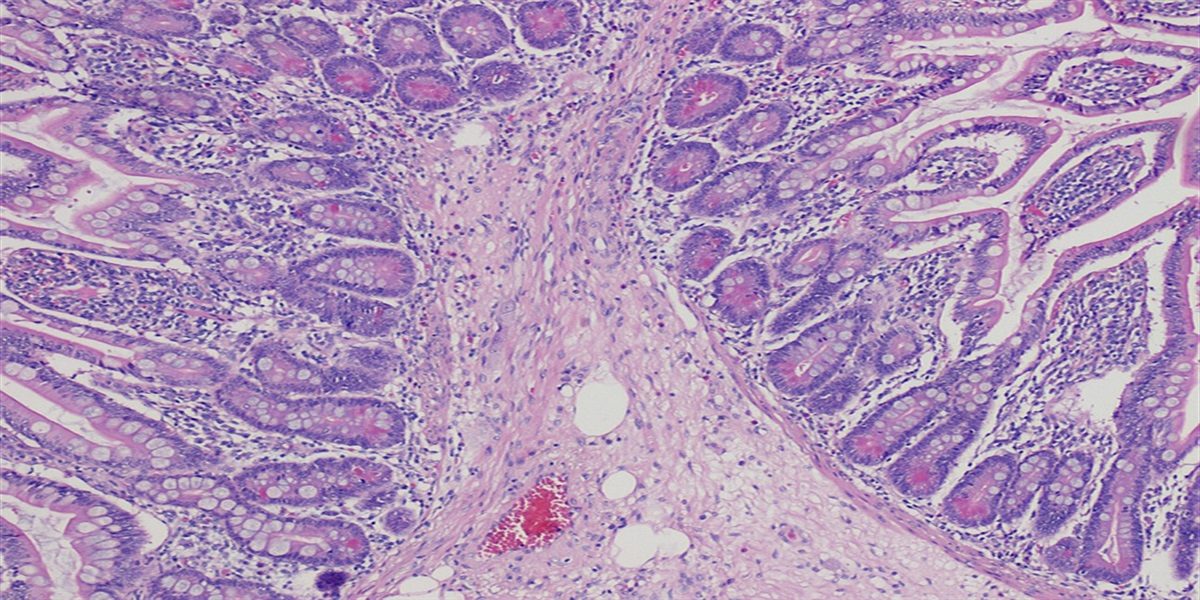 A Case of Pyoderma Gangrenosum after Partial Small Bowel Resection
