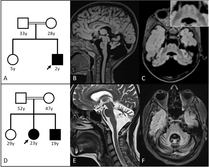 Novel CWF19L1 mutations in patients with spinocerebellar ataxia, autosomal recessive 17