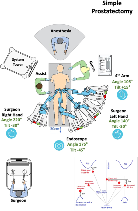 Comparative analysis of robot-assisted simple prostatectomy: the HUGO™ RAS system versus the DaVinci® Xi system