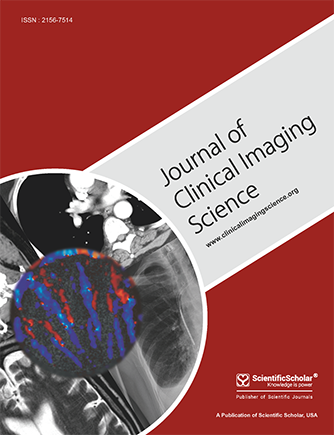 Small-cell cancer of the perihilar bile duct with bleeding esophageal varices: A report of a rare case