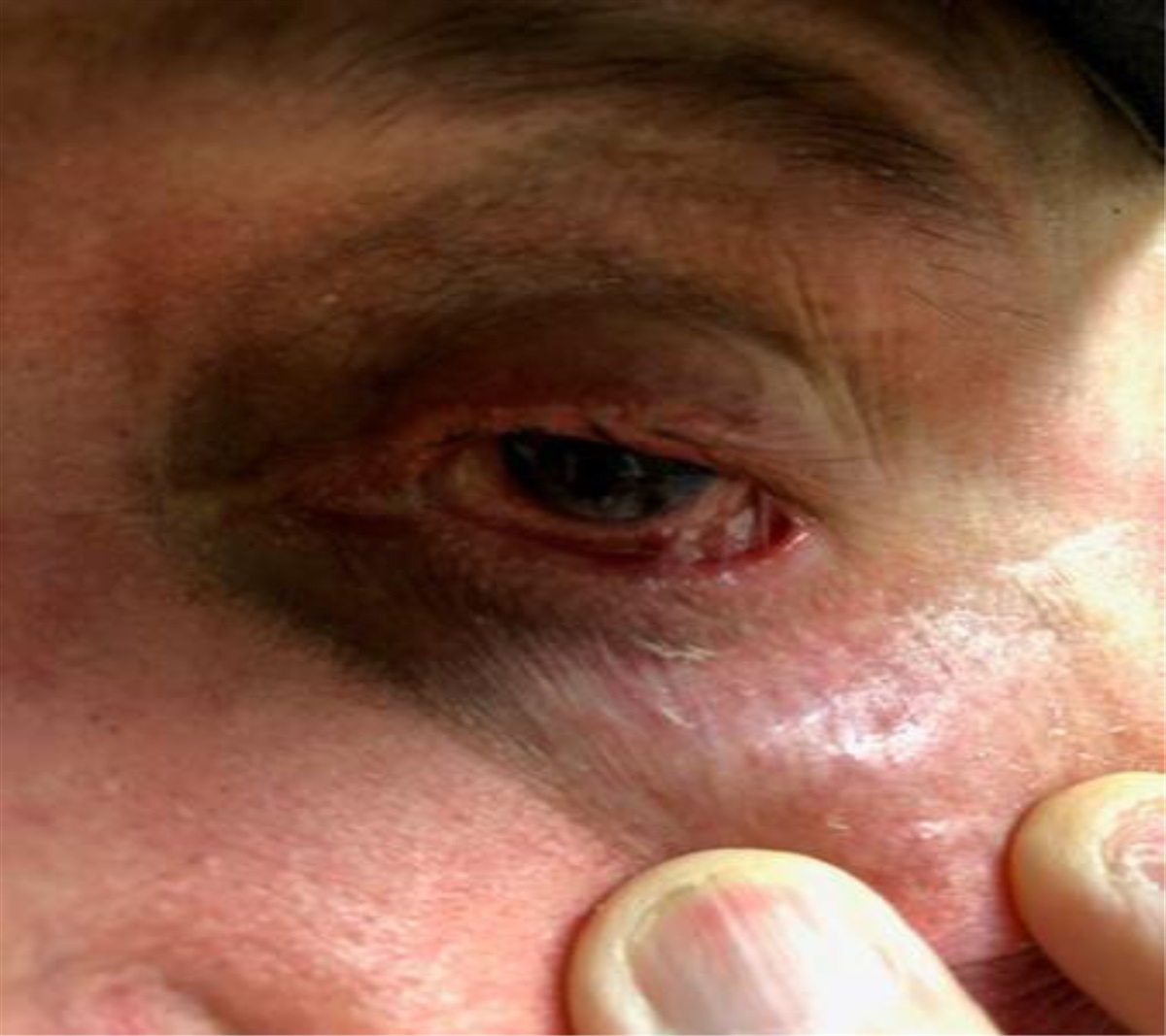 Mucous Membrane Pemphigoid: A Case Report and Brief Literature Update