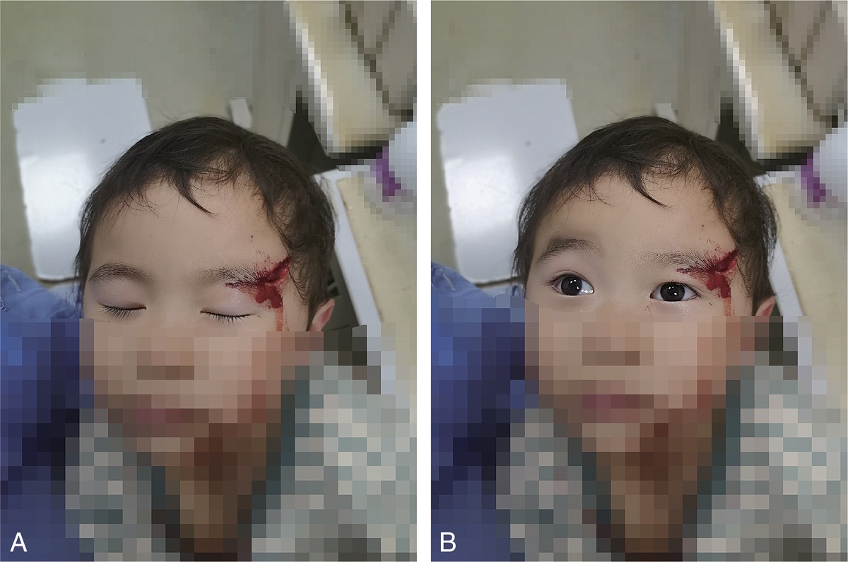 Development of a Semifascicle Graft Technique to Bridge Peripheral Nerve Defect: A Case Report and Animal Study