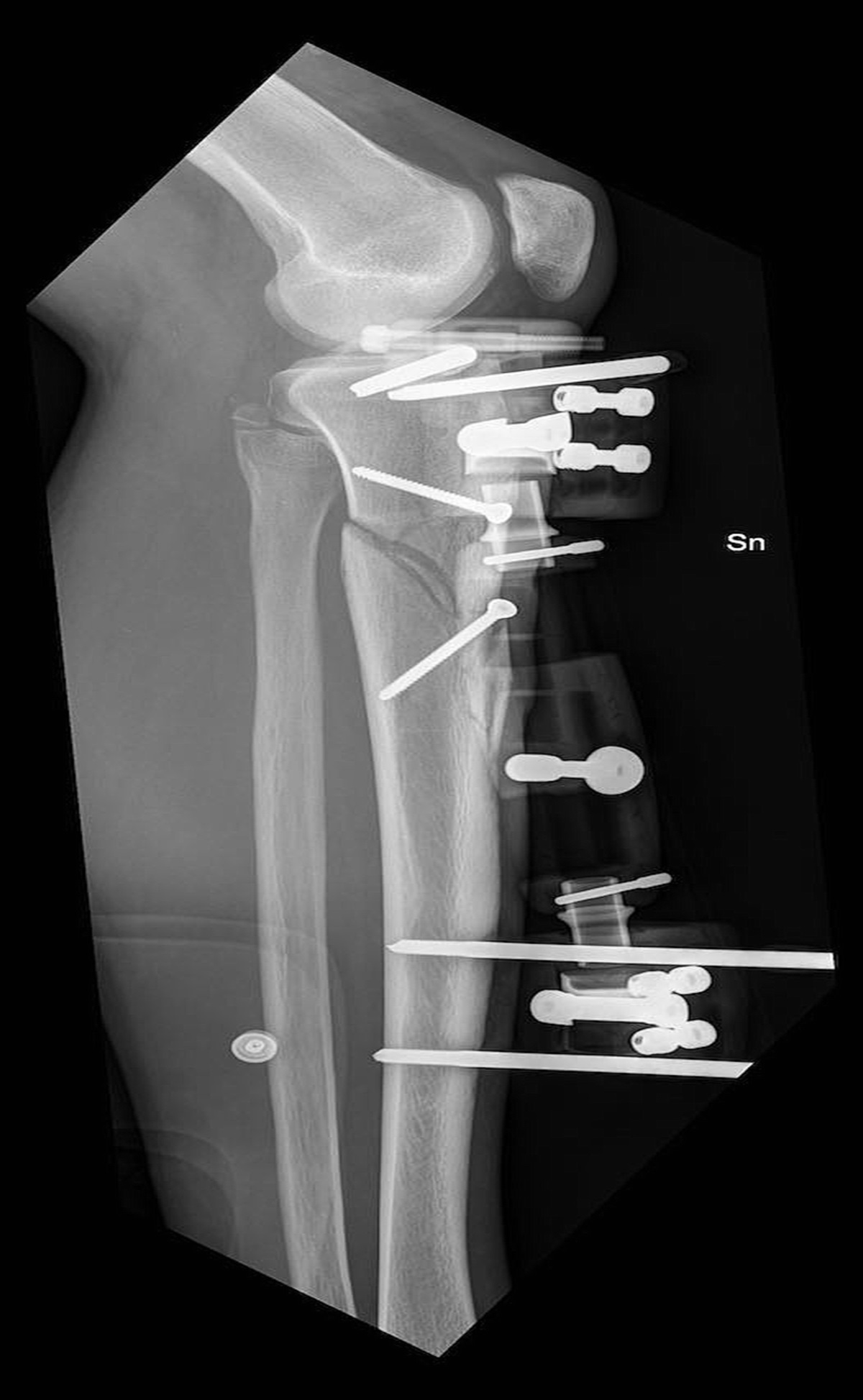 Immediate Soft Tissue Reconstruction in Lower Limb Traumas Using Propeller Perforator Flaps