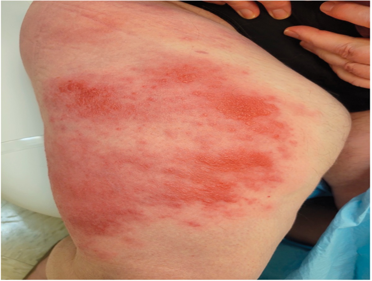 Warm, Erythematous, Edematous Plaques With Overlying Vesicles on the Thigh: Challenge