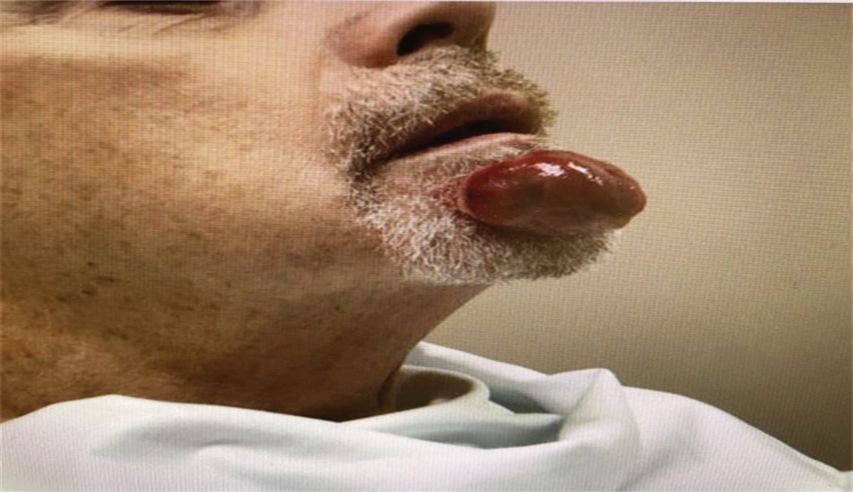 Cutaneous Sarcomatoid Lesion on the Chin: A Clinicopathologic Challenge