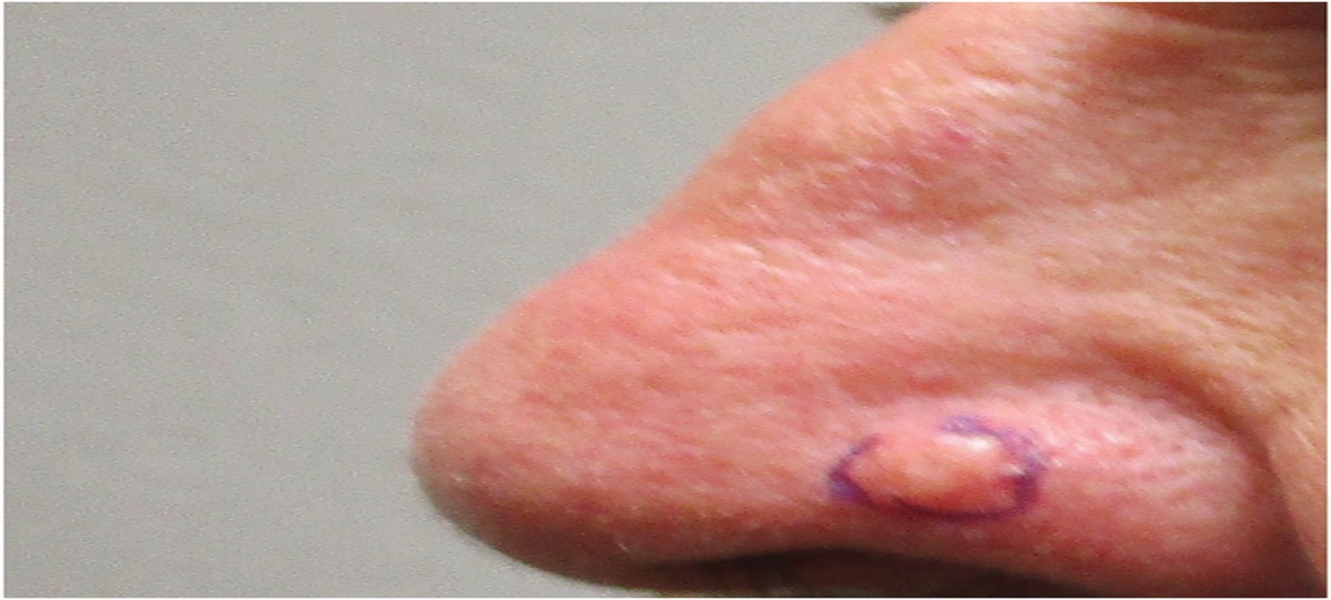 Spindle Cell–Predominant Trichodiscoma With Palisading Arrangement: A Rare Variant