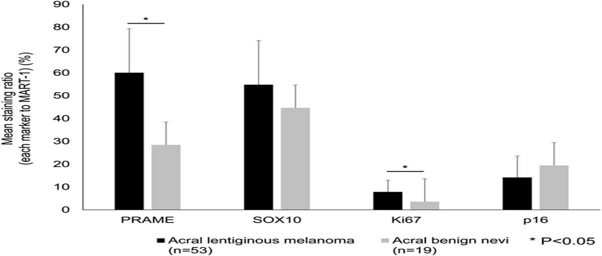 Comparison of Melanocyte-Associated Immunohistochemical Markers in Acral Lentiginous Melanoma and Acral Benign Nevi