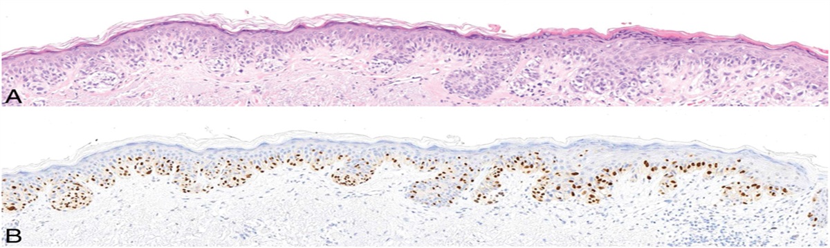 Immunohistochemistry for PRAME in Dermatopathology