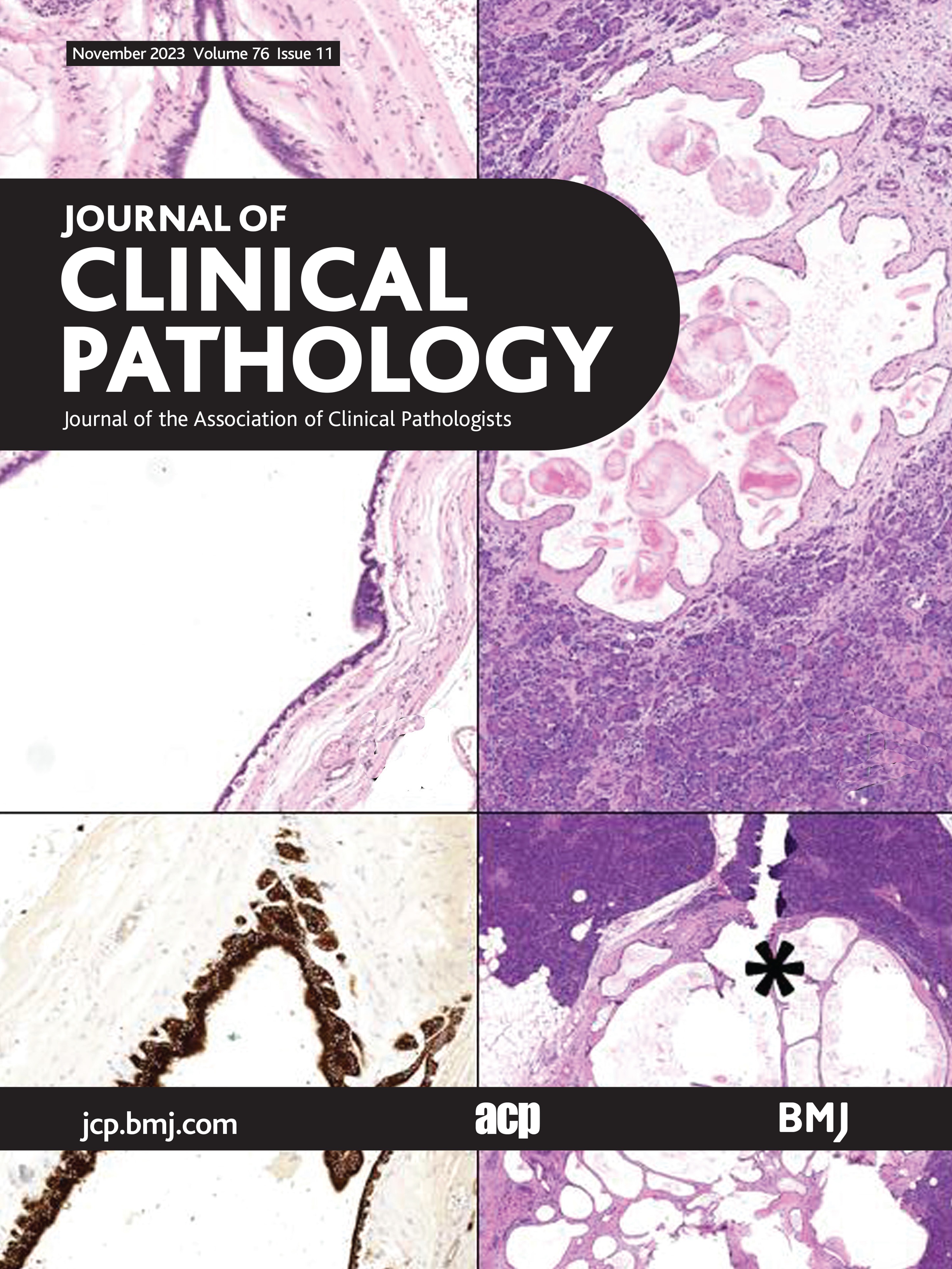 Proposal to distinguish HER2-low from HER2-normal breast cancer by in situ hybridisation