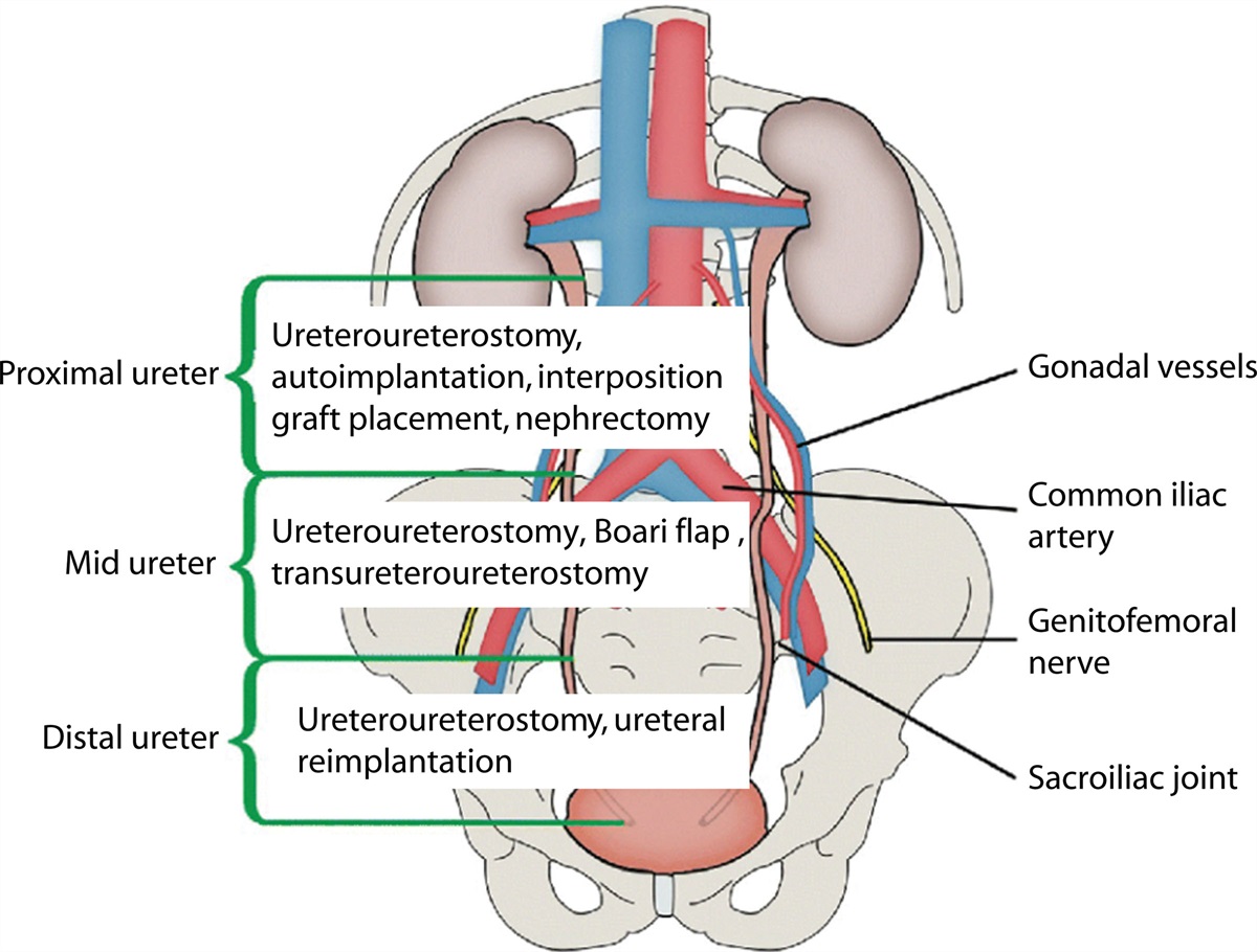 Ureteral Injury