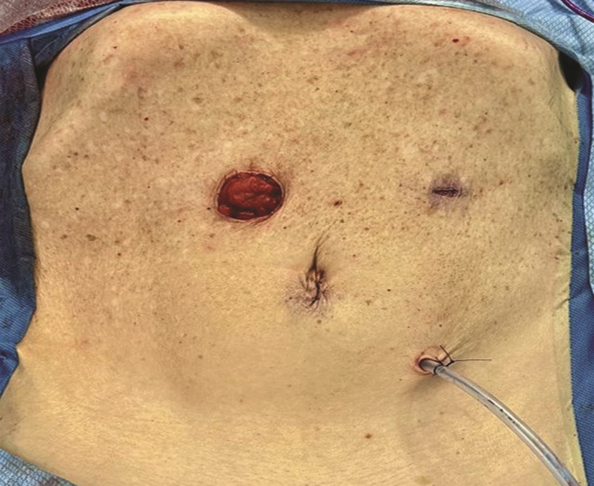 Laparoscopic Total Abdominal Colectomy With End Ileostomy