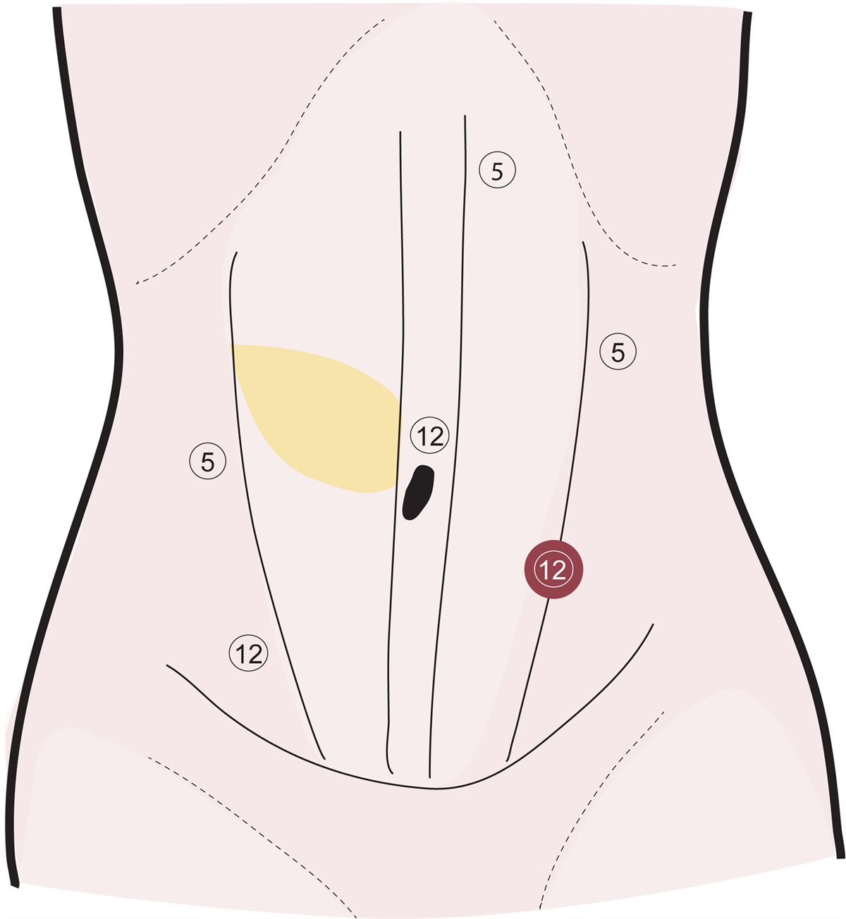 Laparoscopic Oblique Rectus Abdominis Myocutaneous Flap Harvest for Perineal Reconstruction After Abdominoperineal Resection