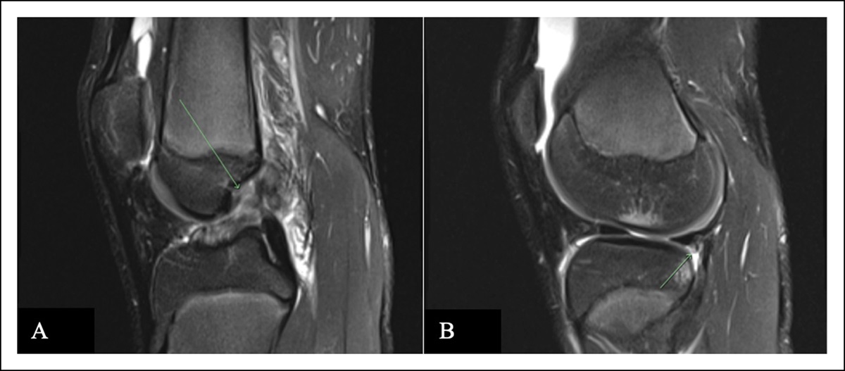 Revision Anterior Cruciate Ligament Reconstruction in Skeletally Immature Patients