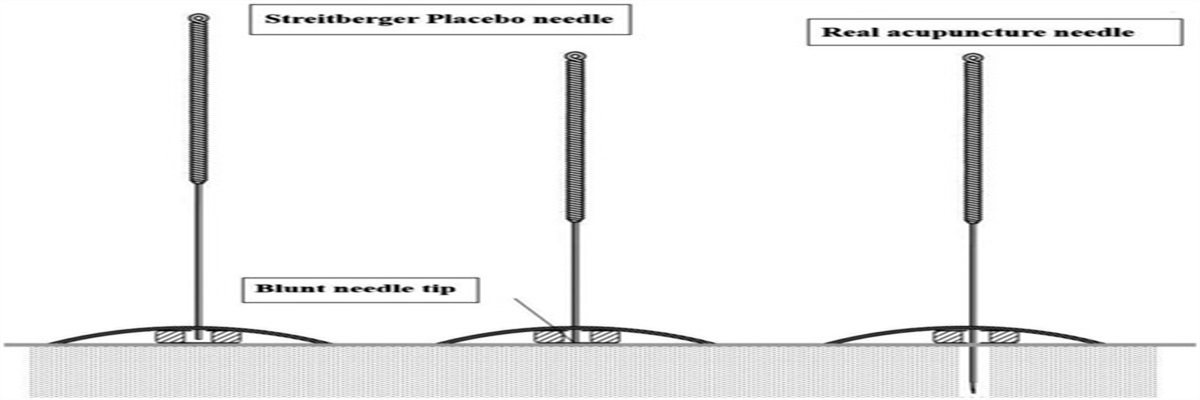 Acupuncture Reduces Severity of Hot Flashes in Breast Cancer: A Randomized Single-Blind Trial