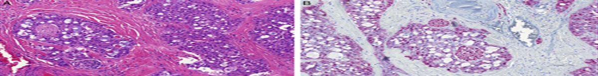 Reply: Salivary Gland Secretory Carcinoma: Clinicopathologic and Genetic Characteristics of 215 Cases and Proposal for a Grading System