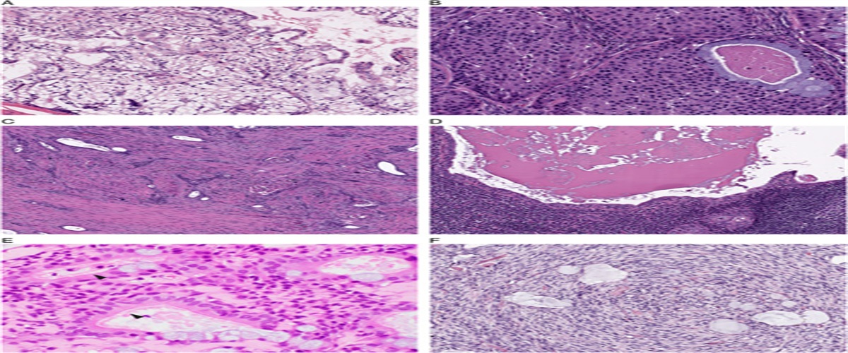 Critical Appraisal of Histologic Grading for Mucoepidermoid Carcinoma of Salivary Gland: Is an Objective Prognostic 2-tiered Grading System Possible?