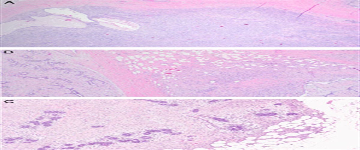 Comprehensive Clinical-Pathologic Assessment of Malignant Phyllodes Tumors: Proposing Refined Diagnostic Criteria