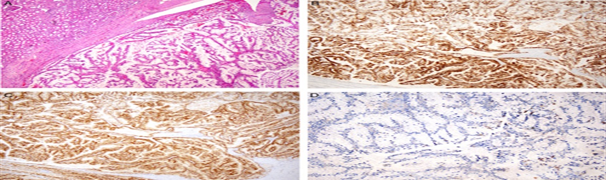 Positive GPNMB Immunostaining Differentiates Renal Cell Carcinoma With Fibromyomatous Stroma Associated With TSC1/2/MTOR Alterations From Others