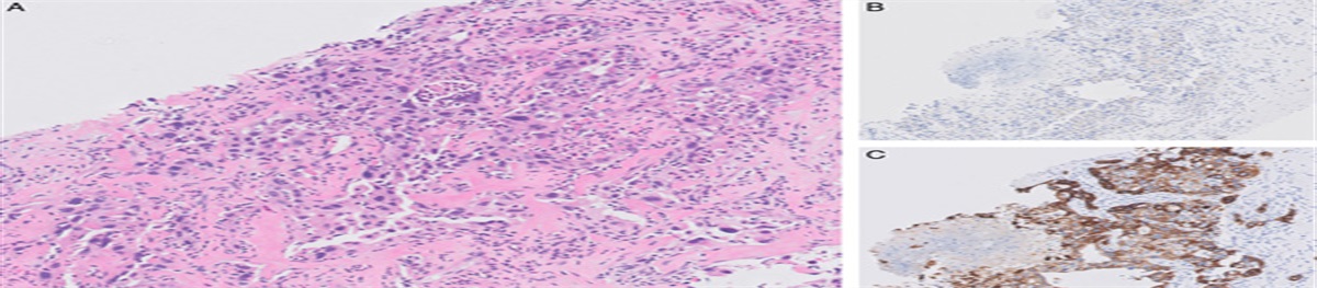 Genomic Analysis in the Categorization of Poorly Differentiated Primary Liver Carcinomas