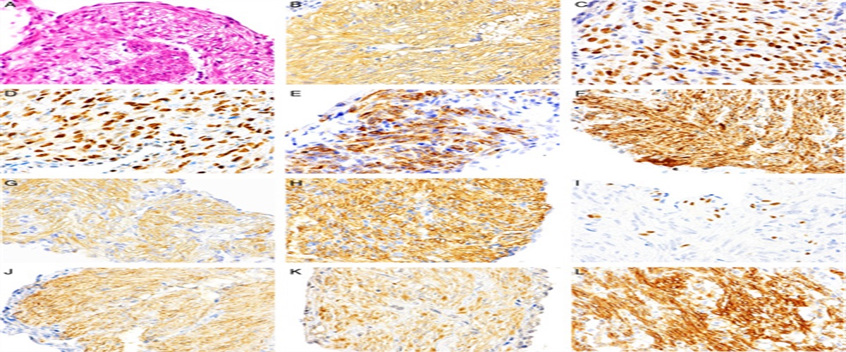 Clinicopathological Impacts of Expression of Neuronal Markers in Lymphangioleiomyomatosis