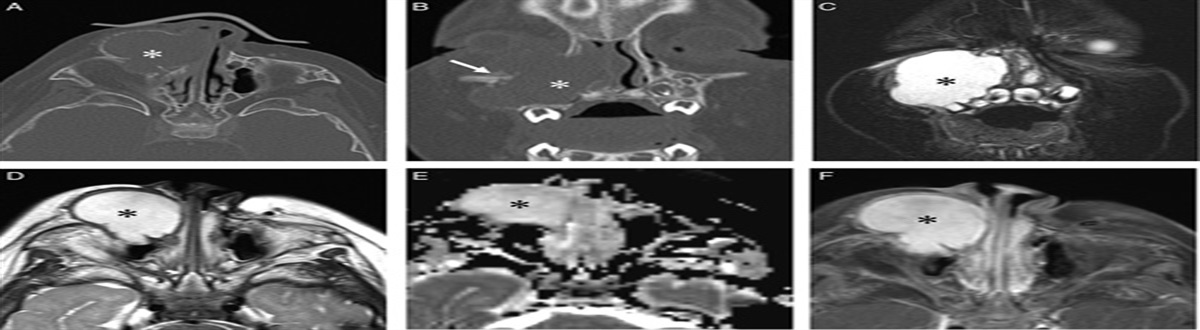 CTNNB1 and APC Mutations in Sinonasal Myxoma: Expanding the Spectrum of Tumors Driven By WNT/β-catenin Pathway