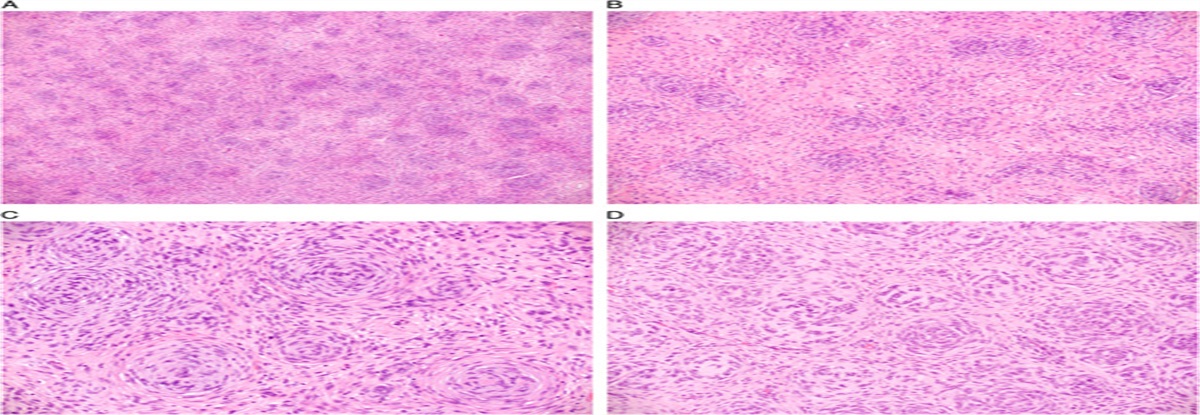 Endometrial/Endometrioid Stromal Tumors With Extensive Whorling and CTNNB1 Translocation: A Report of 3 Cases