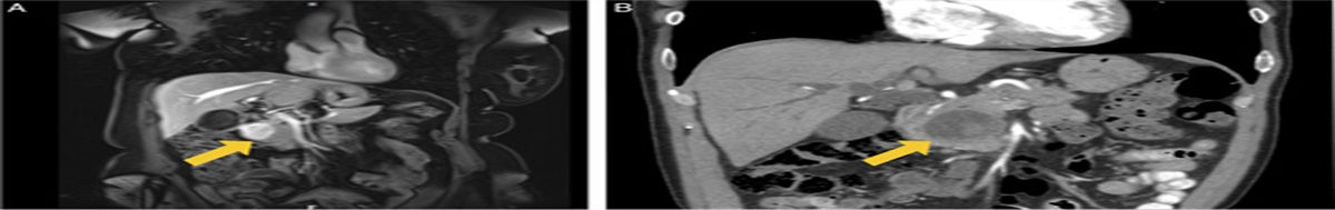 Solitary Fibrous Tumor of the Pancreas: Analysis of 9 Cases With Literature Review