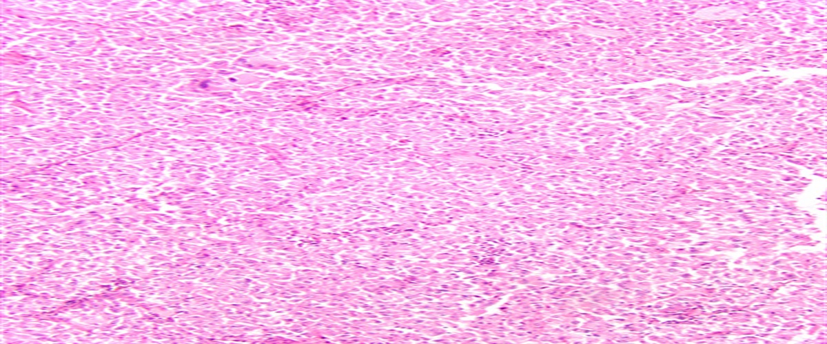 PEComa of the Adrenal Gland: A Clinicopathologic Series of 7 Cases