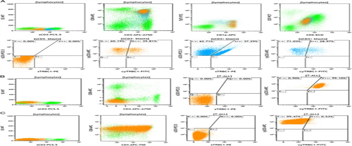 sTRBC1 and cyTRBC1 Expression Distinguishes Indolent T-Lymphoblastic Proliferations From T-Lymphoblastic Leukemia/Lymphoma