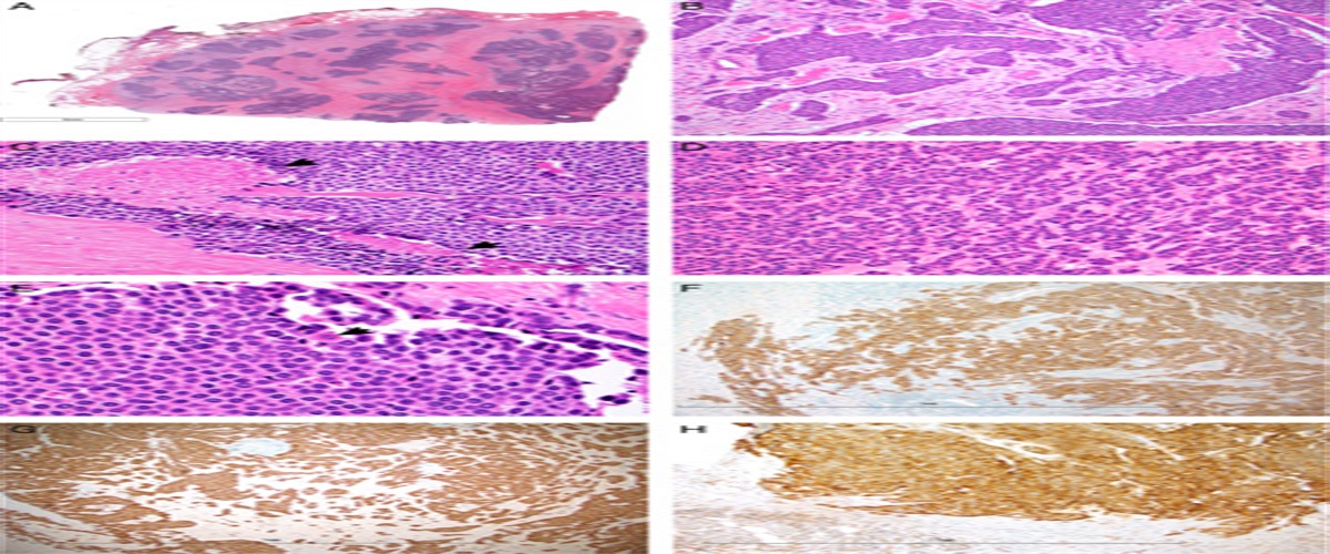 Adamantinoma-like Ewing Sarcoma (ALES) May Harbor FUS Rearrangements: A Potential Diagnostic Pitfall