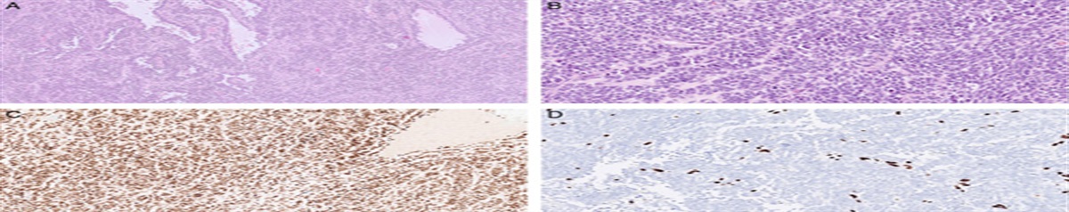 Unusual Aspects of Small Cell Carcinoma of the Ovary of Hypercalcaemic Type: Retained SMARCA4 Immunohistochemical Staining and Positive Staining With TLE1