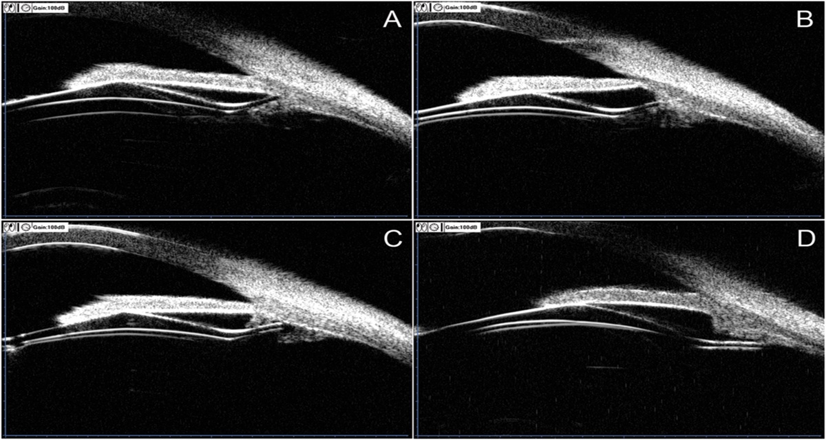 Evaluation of ciliary body morphology and position of the implantable collamer lens in low-vault eyes using ultrasound biomicroscopy