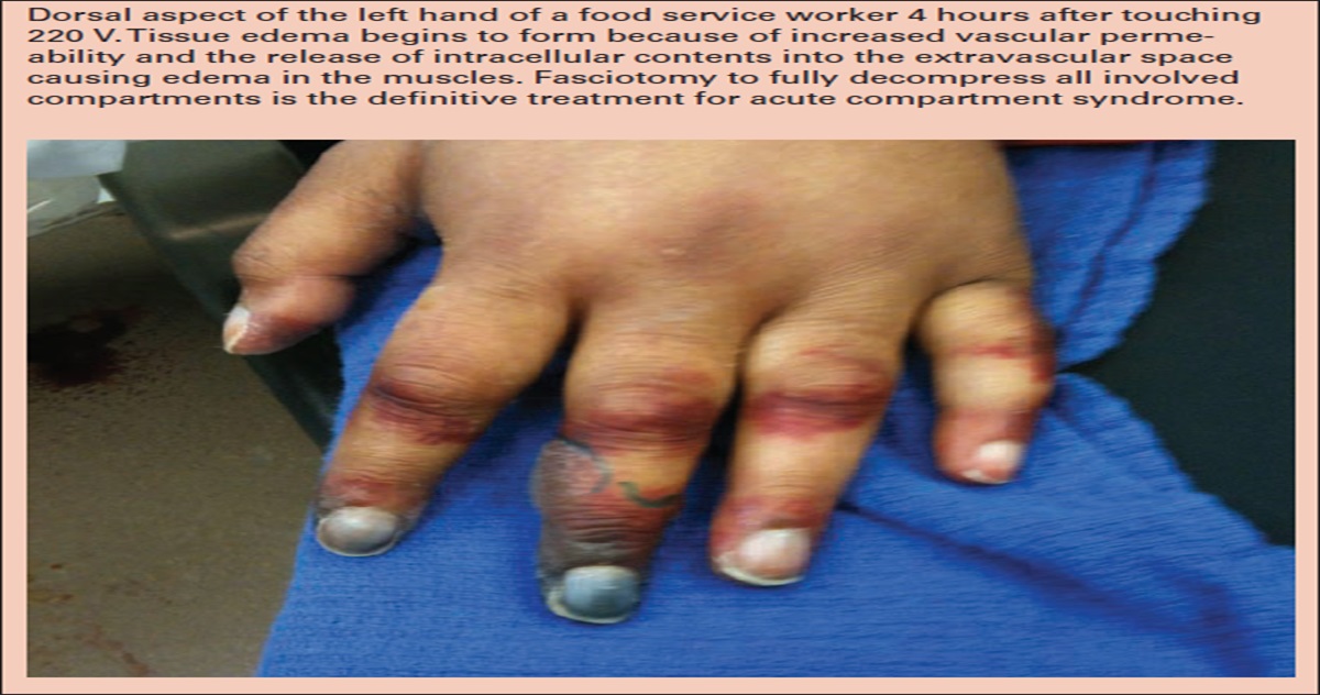 Hidden realities of electrical injuries