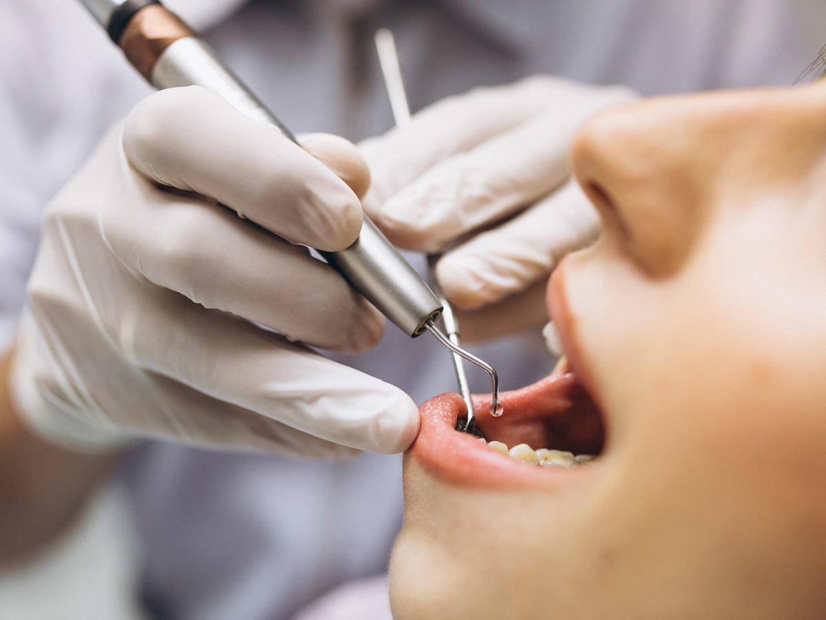 Clinical Decision Support to Reduce Opioid Prescriptions for Dental Extractions using SMART on FHIR: Implementation Report
