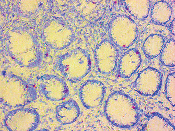 A distinct CD103+Vγ4+ γδ T cell subset is linked to lesion healing and improved prognosis