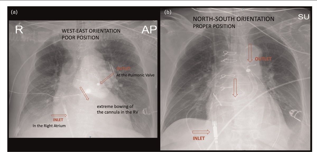 Timing, positioning and ancillary therapies: the triad for successful Impella RP