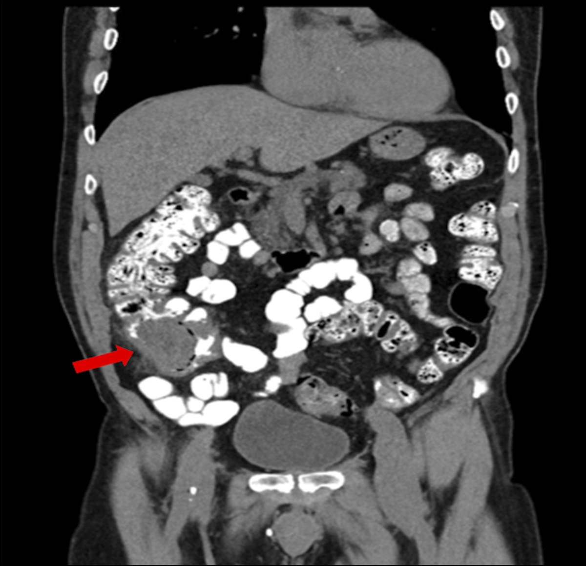 Colonic Mass After NSAID Use and Concerns for Malignancy